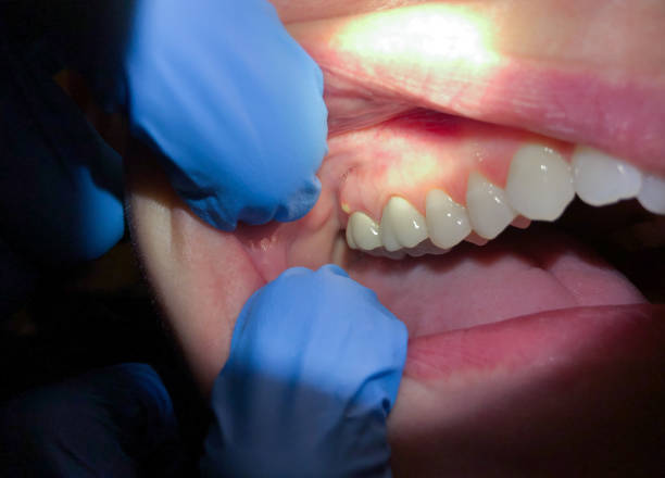 Best Chipped Tooth Repair Near Me  in Westport, WA
